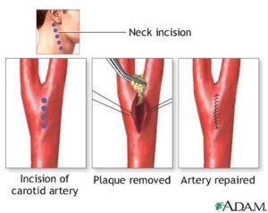 arteria