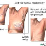mastectomy
