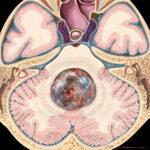 medulloblastoma