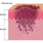 melanoma