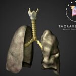 trachea-transplant