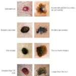bc_carcinoma