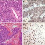ewing_sarcoma