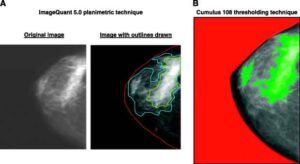 mammographic density 300x164 Densita mammografica: due varianti genetiche la collegano al tumore al seno