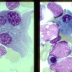 myeloid_leukemia