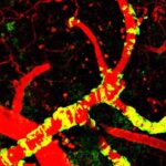 cerebralamyloidangiopathy
