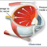 glaucoma