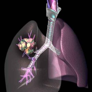 lung-cancer lung cancer 300x300 Fiutare il cancro del polmone al primo stadio
