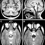 sindrome_joubert