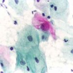 pap test abnormale