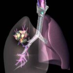 lung-cancer