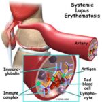 systemic-lupus-erythematosis