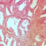 tessuto iperplasia prostatica benigna