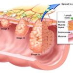 cancer_gene