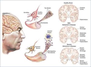 brain_alzheimer brain alzheimer 300x221 Alzheimer: istruzione salva non solo da ignoranza, ma previene la demenza