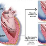 cardiomiopatia