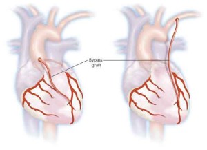 heart2 300x217 Controllare i battiti cardiaci tutte le mattine: cardiologo usa Youtube: il video.