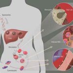 malaria