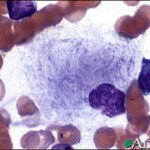 gaucher-cells