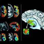 huntington_disease