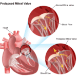 mitralvalve