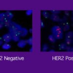 HER2-positive