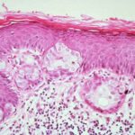 cellule_carcinoma