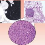 lung-cancer