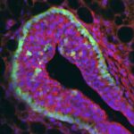 mammarian_cancer