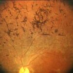 retinite