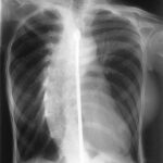 scoliosis