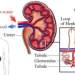 nephrotic_syndrome