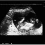 Ultrasound scan to Amniocentesis Test
