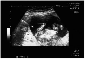 amniocentesi 300x207 Amniocentesi: ricorrere agli antibiotici prima dellesame potrebbe dimezzare rischi aborto