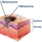 melanocyte4