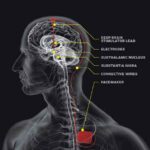 Stimolazione_nervosa_profonda