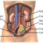ovarian-cancer