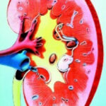 albuminuria