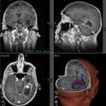 glioblastoma