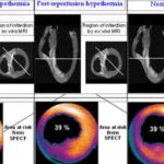 ipotermia_infarto