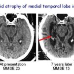 atrofia_alzheimer