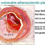 placche_aterosclerotiche