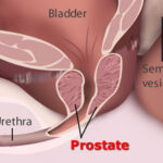 prostata