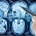 alzheimer_stress