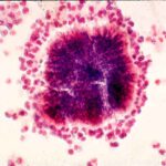 bacterial_infections