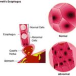 barretts_esophagus_heat