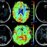 glioblastoma