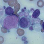 leucemia_mieloide