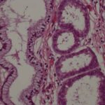 peostatic_carcinoma