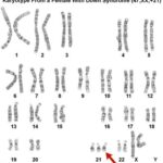 trisomia 21